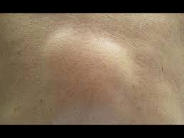 These cysts and bumps can be painful, small or big. 12 Home Remedies To Treat Armpit Lumps Boldsky Com