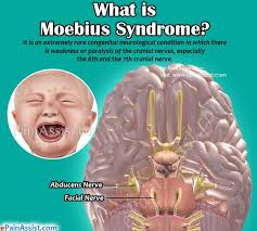 Serge ouanounou, gaurav saigal and sherri birchansky. Moebius Syndrome Causes Symptoms Treatment Diagnosis