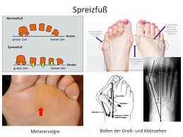 Fussspezialist Berlin Hallux Valgus Operationen Dr Med T Raslan