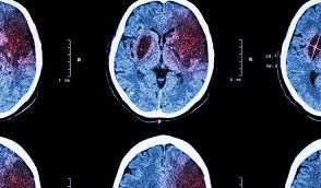 Rehabilitation program cerebrovascular pathology is one of the most complicated and. How Fast Can Acute Stroke Treatment Become To Still Be Reliable Stroke Thrombolysis Treatment In Helsinki Beats Expectations University Of Helsinki