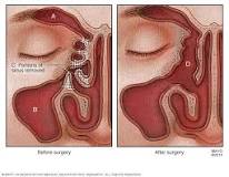 Image result for what causes chronic sinusitis in babies treatment