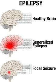Ten percent of people are expected to experience a seizure at some point during their lifetime, but would you know what to do if someone was having a seizure right next to you? How Do I Cope With Epilepsy After Stroke Arni