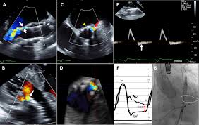 Authorisation to issue statutory instruments. Guidelines For The Evaluation Of Valvular Regurgitation After Percutaneous Valve Repair Or Replacement Journal Of The American Society Of Echocardiography