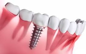 If you're patient and determined to make it work, you'll be able to find a dentist you can afford to. Dental Implants Lincoln Tooth Replacement Smile Specialties