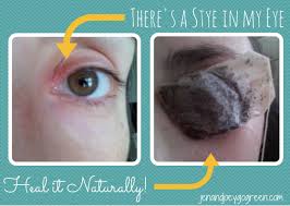 Go Green There S A Stye In My Eye Heal It Naturally Eye Heal Stye Remedy Eye Stye Remedies