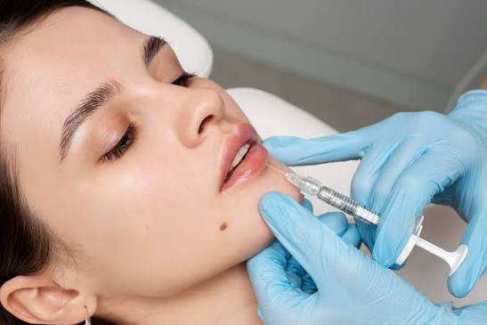 Lip Fillers at Namaa Clinics