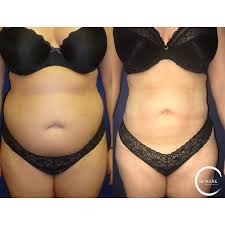 Maybe you would like to learn more about one of these? Top Brazilian Butt Lift Bbl Surgeon Boston Ma Dr Mark Markarian