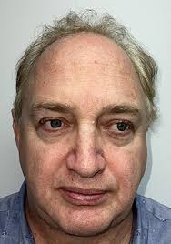 Permanent Hair Transplant Surgery Cost in New Jersey Hunterdon Newport