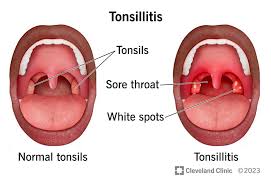 Image result for Tonsillitis