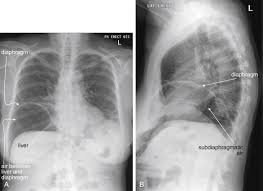 Normal chest x ray anatomy. Imaging The Chest The Chest Radiograph Radiology Key