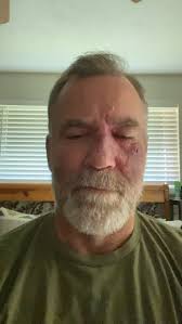 Well it’s time.knee surgery number 3! It’s just another reminder of the  sacrifices I’ve put my body through in my prior profession. This won’t stop  me though! It just allows my team to catch up or ...