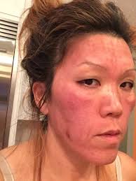 Always consult your doctor before starting or changing any medication. Is Hyperpigmentation Normal After Microneedling Photos