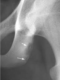 Image result for Pubic Apophysitis