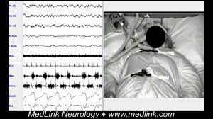 Image result for Stridor