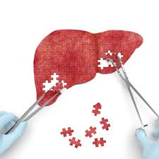 A type of liver cancer that usually does not spread outside the liver. Hiv And Your Liver Poz