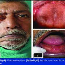 PDF) Lip and Lower Lid Supporting Prosthetic Appliance: A Unique Approach  of Treating Unilateral Facial Paralysis