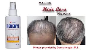 Typically at least the head is involved. Medimar Sa We Are Making Hair Loss History Redenyl