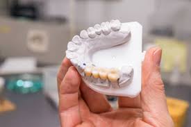 Also known as a false tooth) and its abutments (supporting prosthetic caps for the prepared adjacent teeth), which together makes a bridge. Dental Bridges Durrani S Dental Clinic Porcelain Dental Bridges
