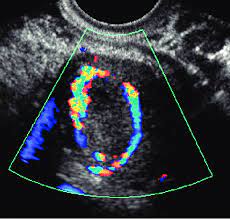 Ovarian cancer screening is not actually recommended for people at an average risk of developing the condition. Color Doppler Image Of The Right Ovary Demonstrates The Typical Ring Download Scientific Diagram