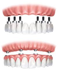 Before and after dentures implants. All On 4 Surgery Recovery Dental Implants