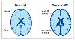 Ms Progression