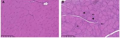 Maybe you would like to learn more about one of these? Histopathologic Changes In Skeletal Muscle Tissue From Quadriceps Download Scientific Diagram