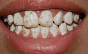 Maybe you would like to learn more about one of these? Speck Na Zube V Dietatu Je 1 Rok Biele Skvrny Na Zuboch V Dietatu Priznaky A Priciny Choroby