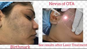 Nevus of OTA