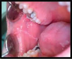 Image result for Labial mucosa