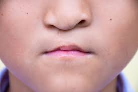 Image result for Cleft Lip