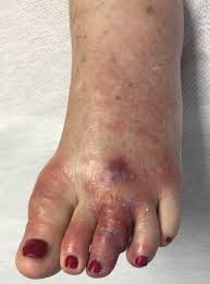 Image result for Pyoderma Gangrenosum