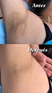 Blanqueamiento íntimo profesional: Láser y Peelings. Seguro, discreto y  eficaz en Esthetic Care ✓Aclara y unifica el tono de la piel de la zona  vulvar y perianal de manera segura y efectiva.