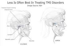 Image result for what are treatment option for tmj