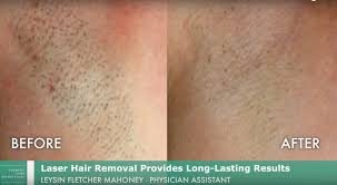 Having smooth, hairless skin is within reach at california vein & laser in fresno, ca, where we offer laser hair removal. Laser Hair Removal Medical Spa San Diego Ca Clderm