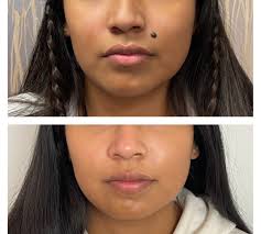 Mole Removal Albuquerque NM, D. Eric Tuggle, D.D.S.