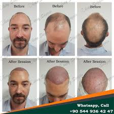 Dr Zen Hair Clinic Olcay Saygin In 2020 Hair Transplant Hair Clinic Hair Transplant Results
