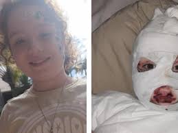 Fundraiser by Hannah Jacobs : 8yo female burn victim austic adhd