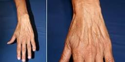 Hand Vein Causes & Treatments - San Diego Cardiac Vein and Laser ...