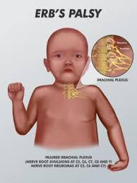 Erp S Palsy