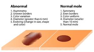 Atypical moles that change in any way might be early melanoma. Moles What To Look For And When To Worry