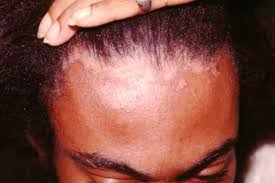 Image result for Seborrheic Dermatitis