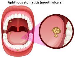 The blisters may be sore for seven to 10 days. How To Get Rid Of Canker Sores And What Can Happen If You Don T