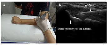 Image result for Epicondyle Injection