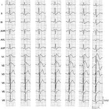 It stores water in that hump and uses the water to sustain itself while in the desert far from an oasis it can use. Pdf Proposed Diagnostic Criteria For The Brugada Syndrome Consensus Report