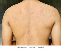 Image result for sweat rash on back