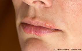 Ich trage jeden abend vor dem schlafen gehen honig auf meine lippen, ist das auf die dauer schlecht. Lippenherpes Ursachen Symptome Behandlung Meine Gesundheit