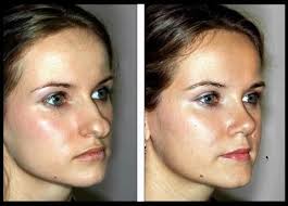 Rhinoplasty To Correct A Wide Nasal Tip 2 See This Young Woman S Before After Nose Plastic Surgery Nose Reshaping Rhinoplasty