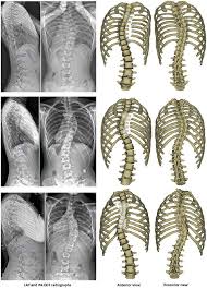 Rib cage, basketlike skeletal structure that forms the chest, or thorax, made up of the ribs and their corresponding attachments to the sternum and the vertebral column. Example Of A Rib 3d Reconstruction First Estimate A And Solution Download Scientific Diagram