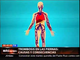 En estas circunstancias, se dice que una persona está experimentando una trombosis. Mas Que Noticias Trombosis En Las Piernas Causas Y Consecuencias Youtube