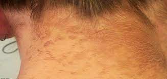 Cladosporium sphaerospermum en 2007, investigadores del colegio de medicina albert einstein, de nueva york, publicaron en plos one un estudio en el que describían cómo la radiación. Por Que Tienes Manchas Oscuras En El Cuello Clinica Internacional